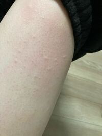 ダニのアレルギー症状の改善対策法は？蕁麻疹のように皮膚に出来る正体は？